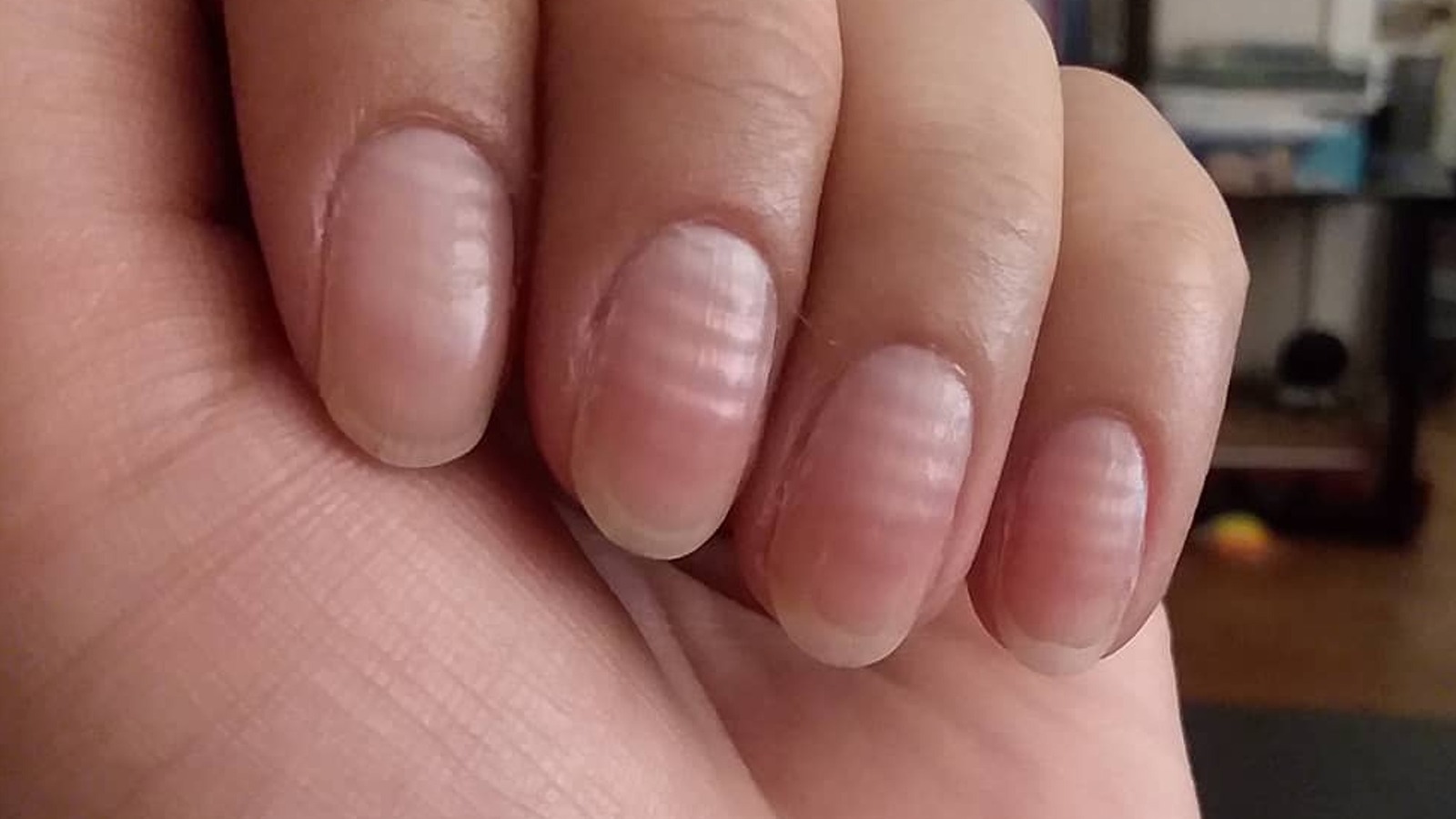 nail ridges