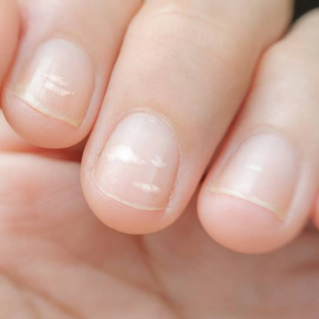 white spots on nails