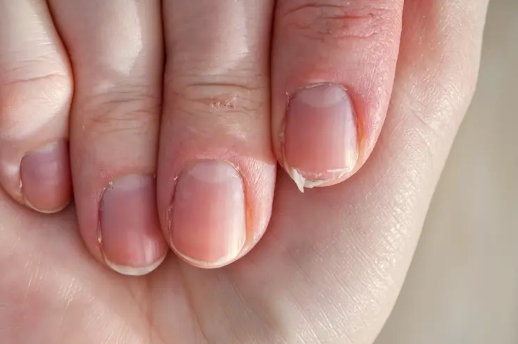weak nails